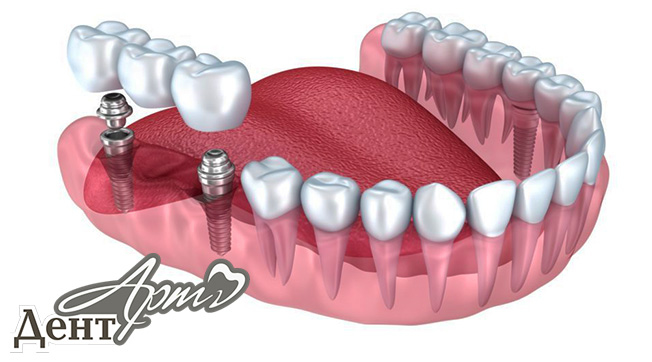 Безболезненное лечение в стоматологии ДентАрт